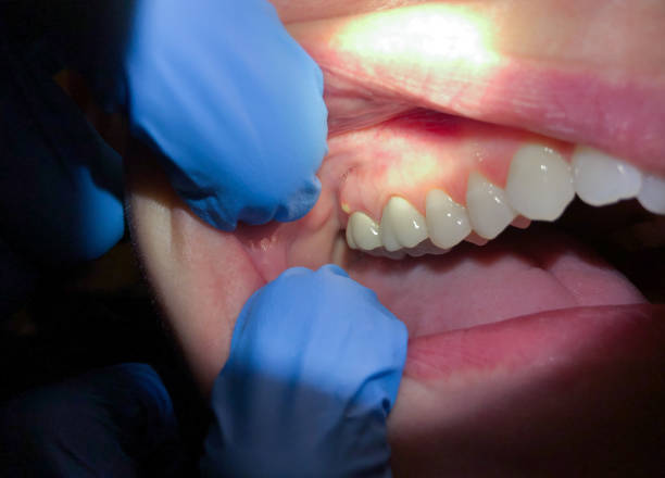 Best Emergency Care for Gum Disease in Tellico Plains, TN